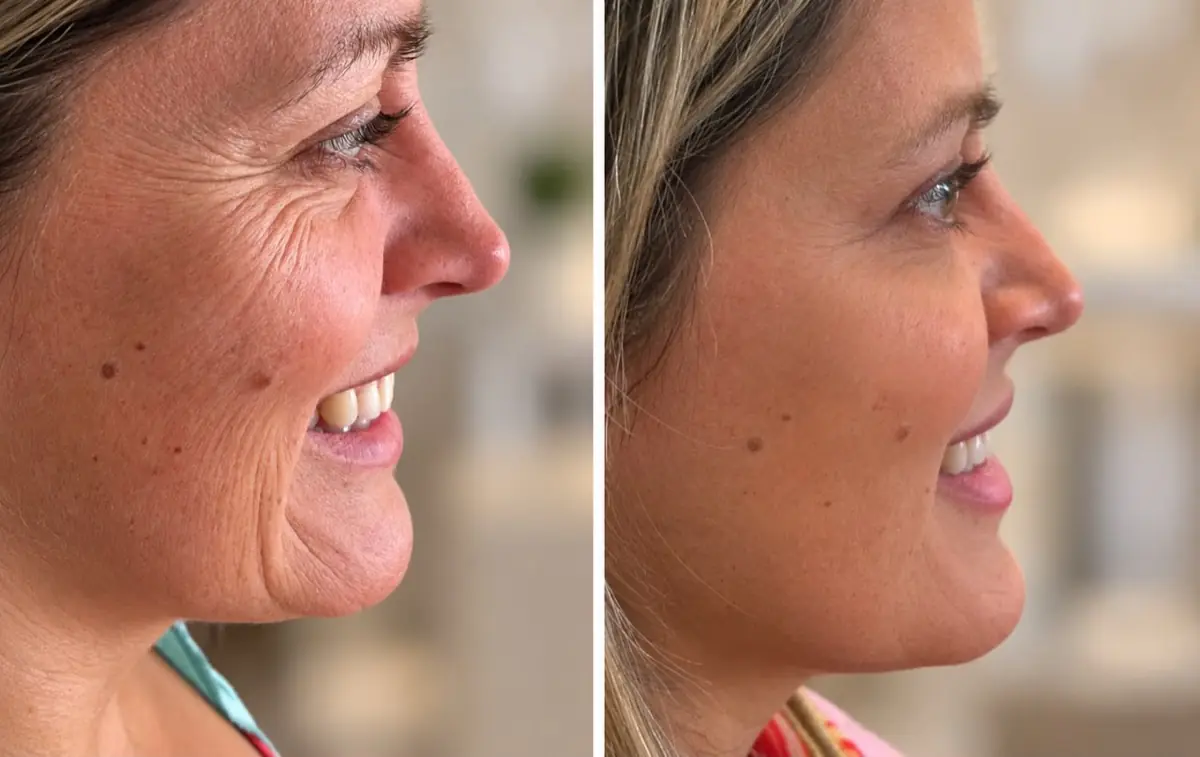 Antes y después de toxina botulínica en la frente — Clínica Proface