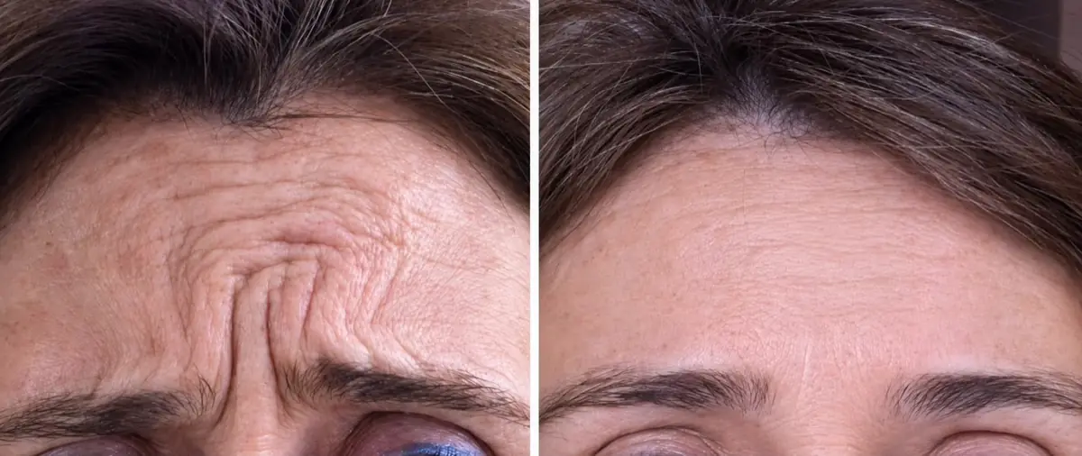 Antes y después de toxina botulínica en líneas de expresión — Clínica Proface