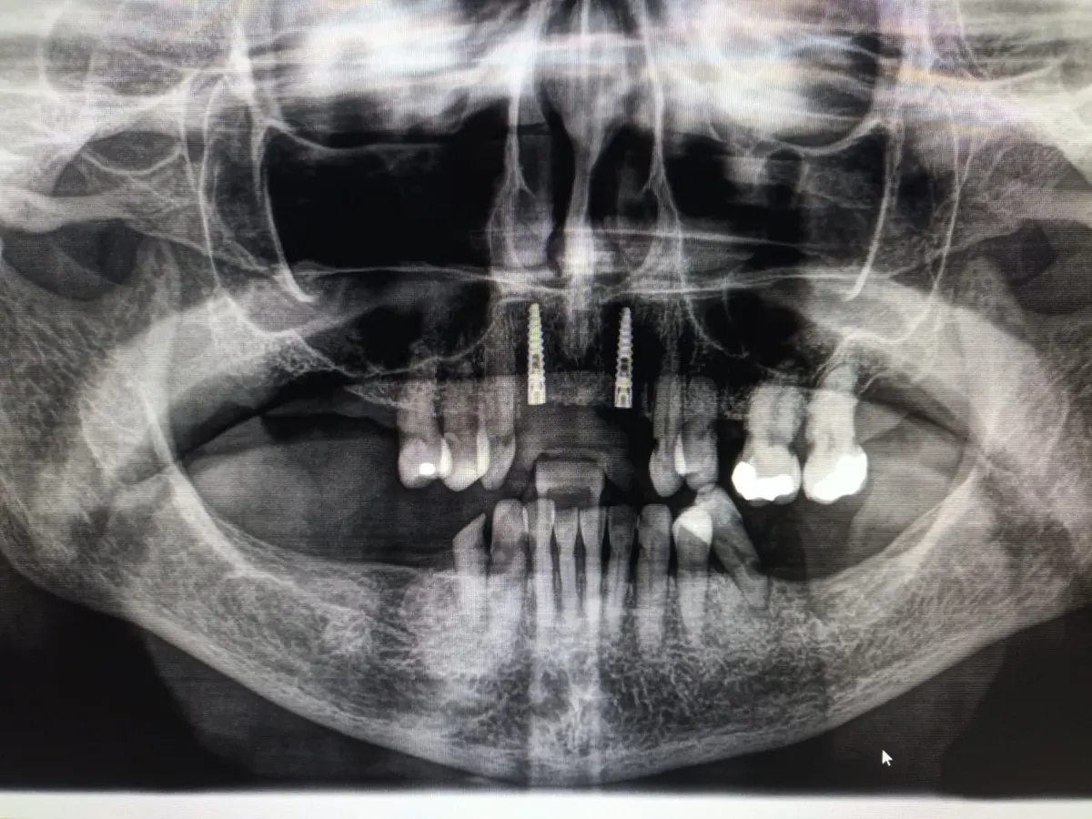 Radiografía panorámica con dos implantes integrados en el maxilar superior — Clínica Proface