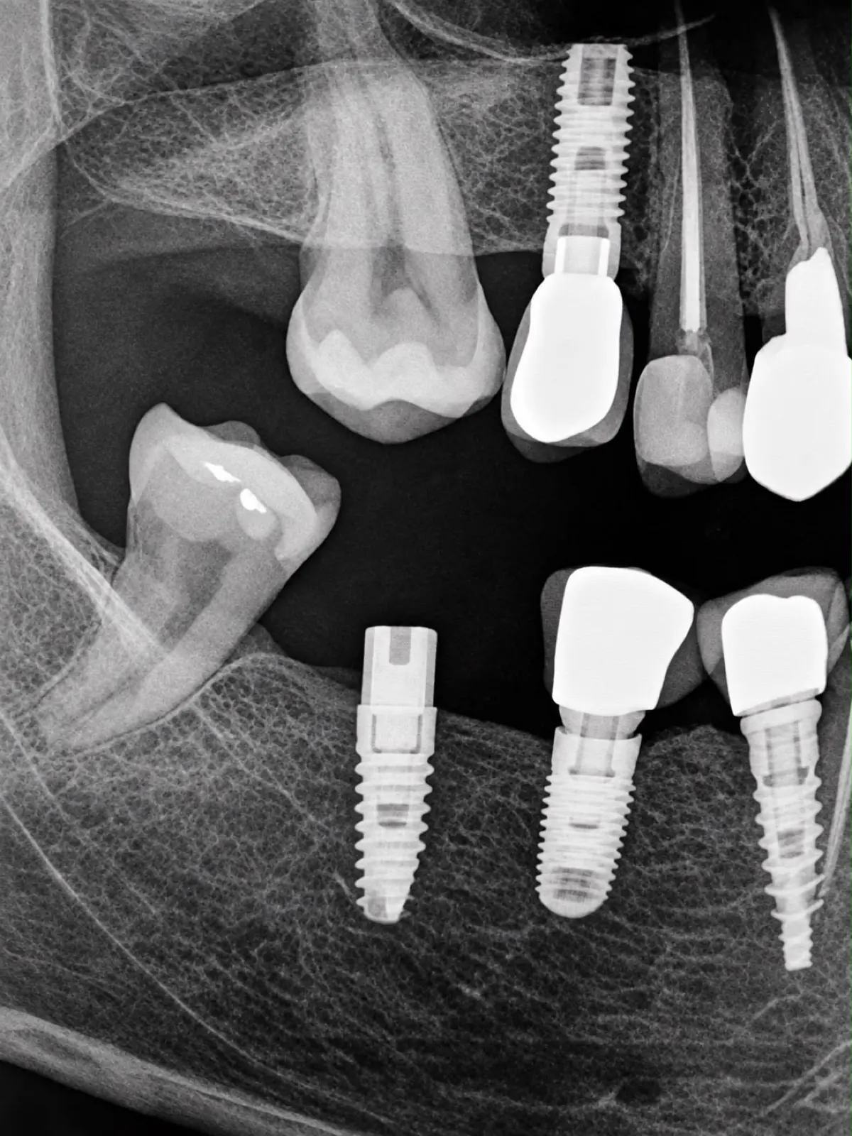 Radiografía de implantes con sus coronas en ambos maxilares — Clínica Proface
