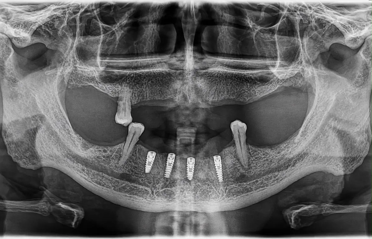 Radiografía panorámica con cuatro implantes en el maxilar inferior — Clínica Proface