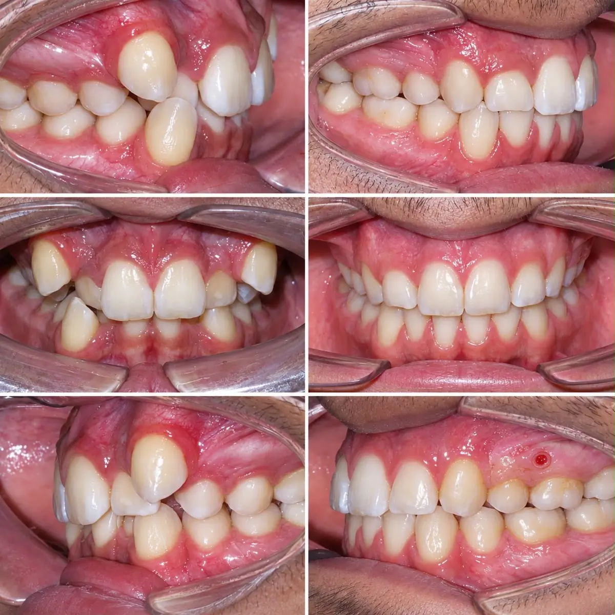 Antes y después de un tratamiento de ortodoncia fija para apiñamiento dentario severo — Clínica Proface